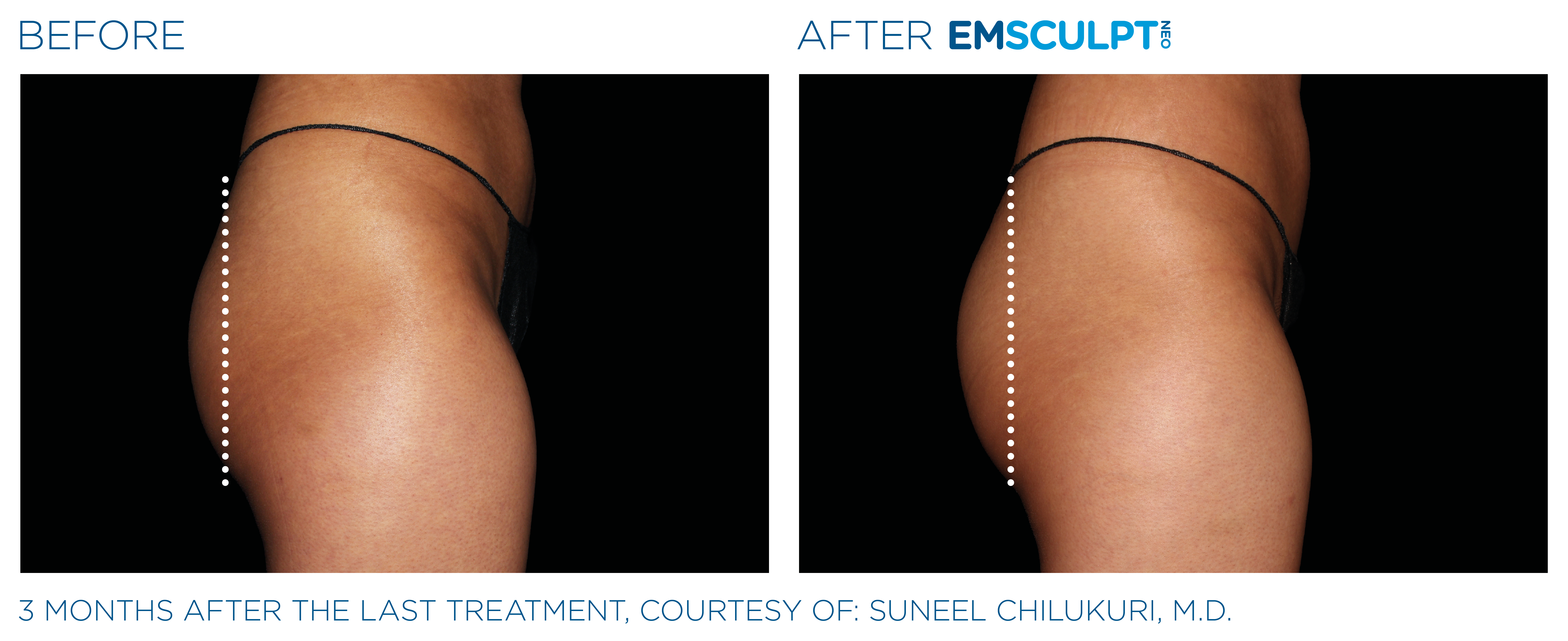 EMSCULPT NEO Results 2