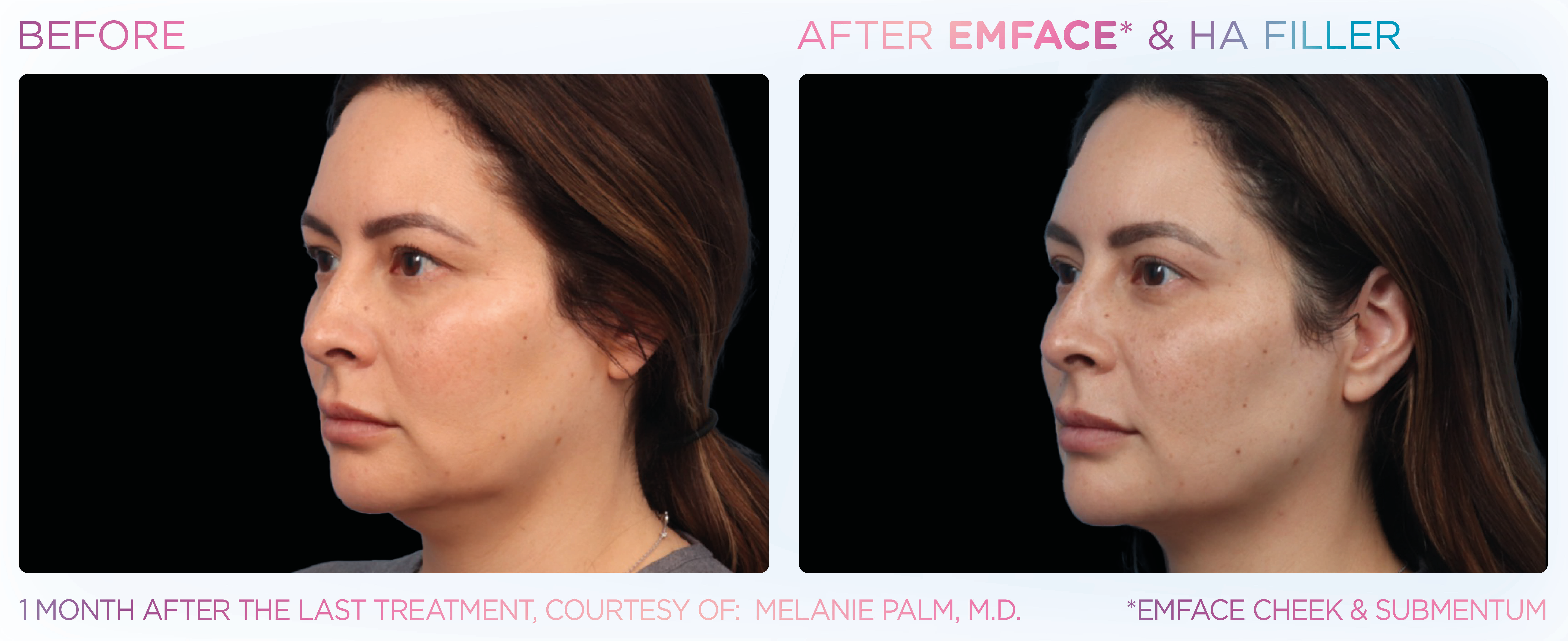 EMFACE Treatment