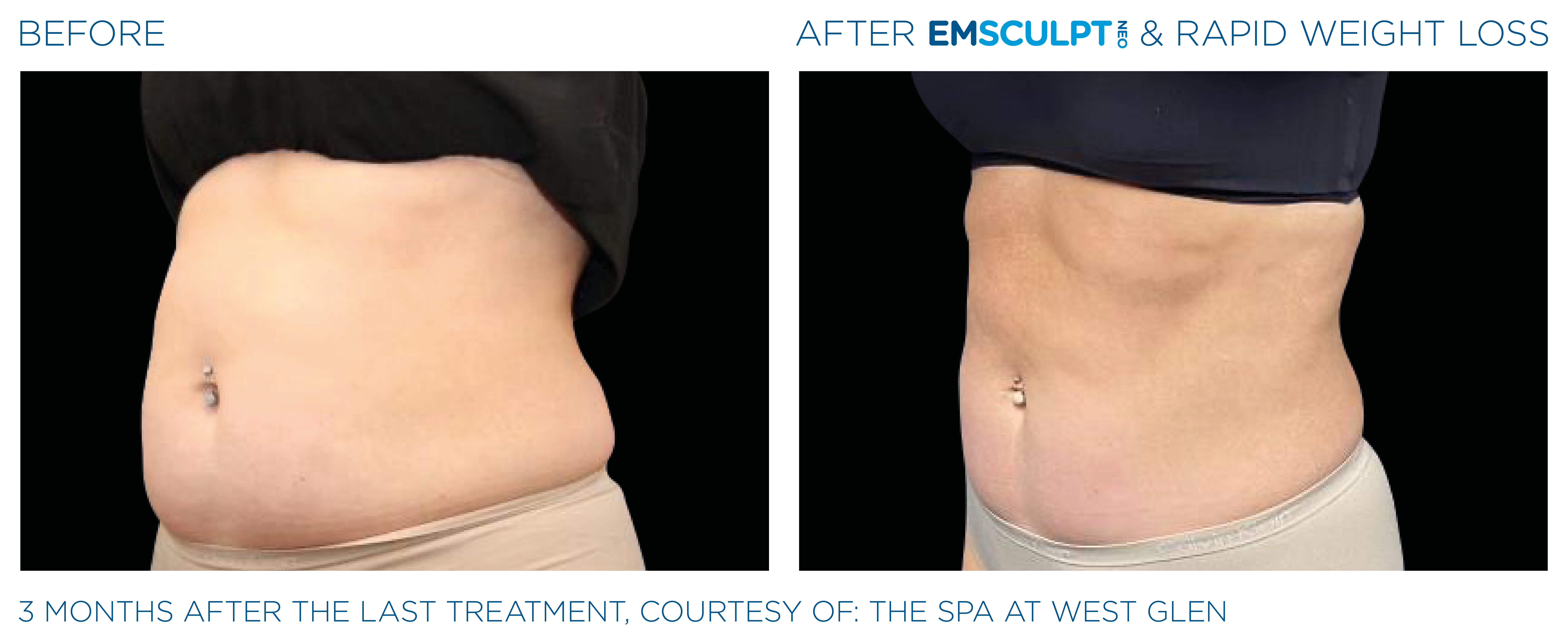EMSCULPT NEO Results 3
