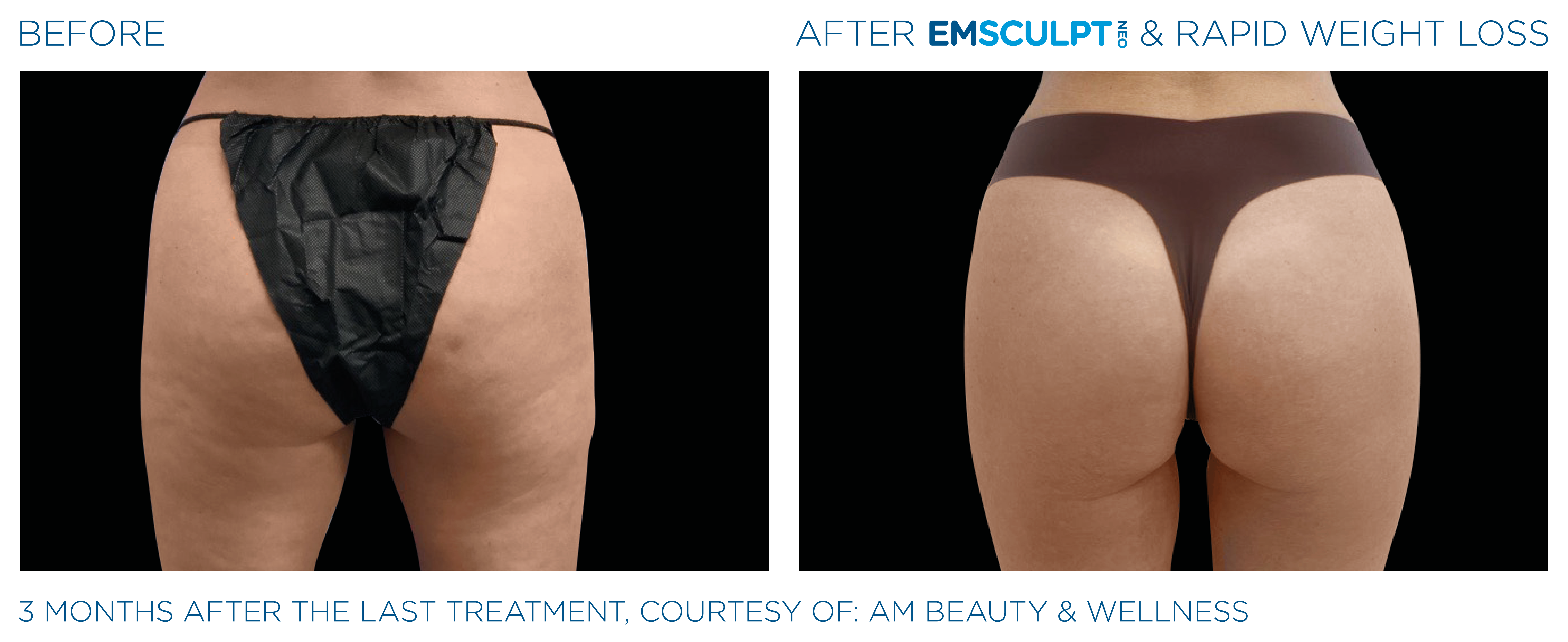 EMSCULPT NEO Results 7