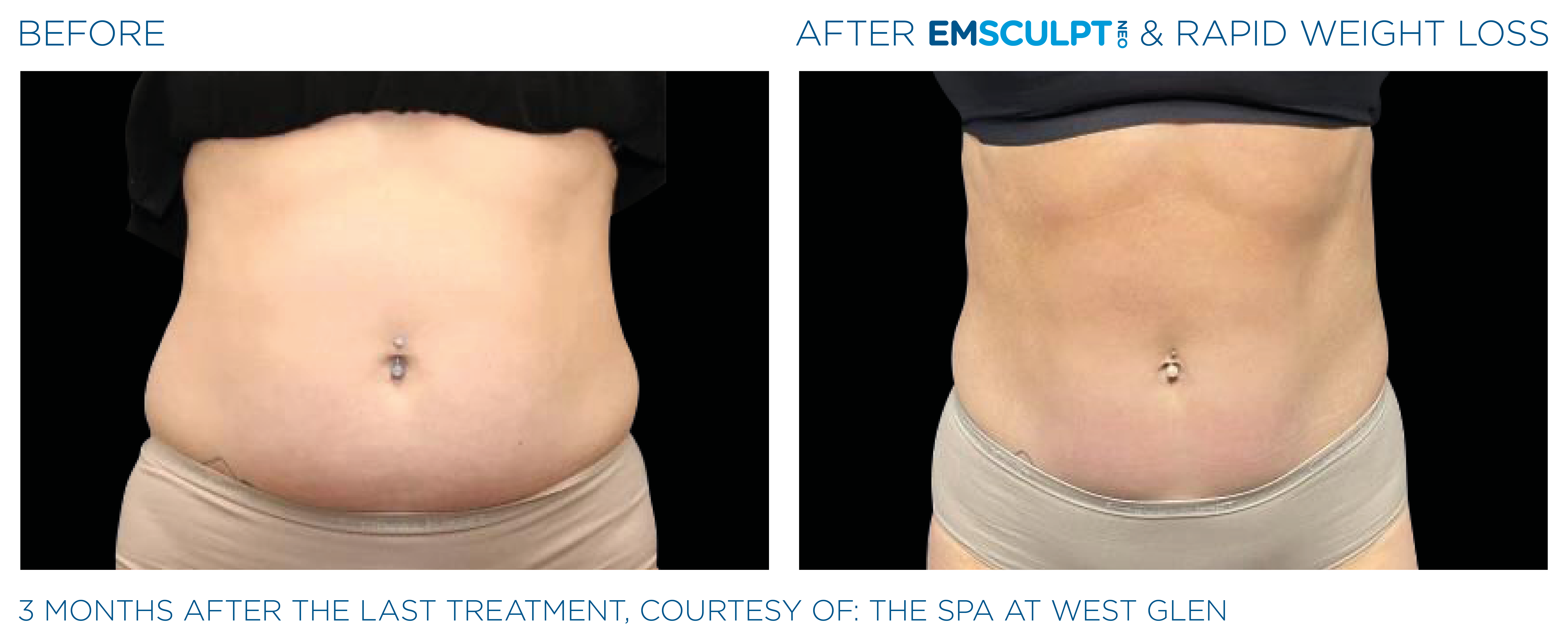EMSCULPT NEO Results 5