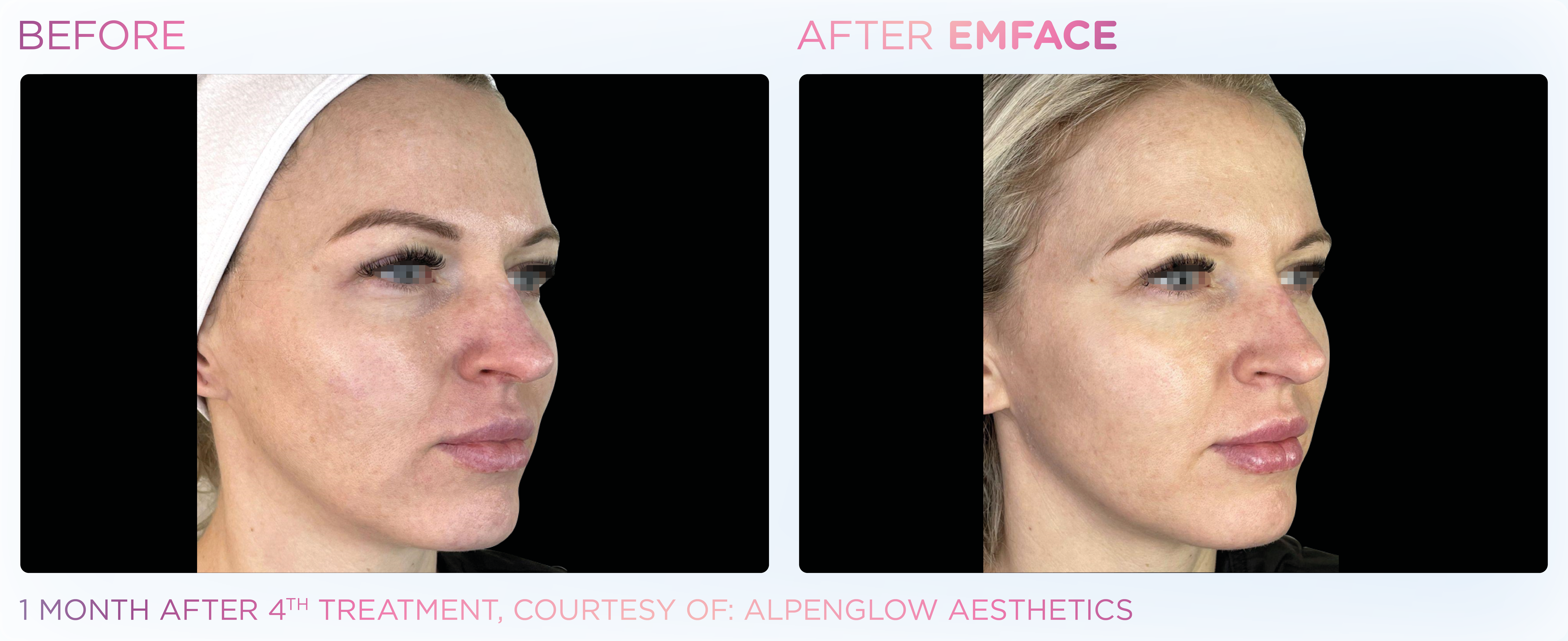 EMFACE Treatment Process