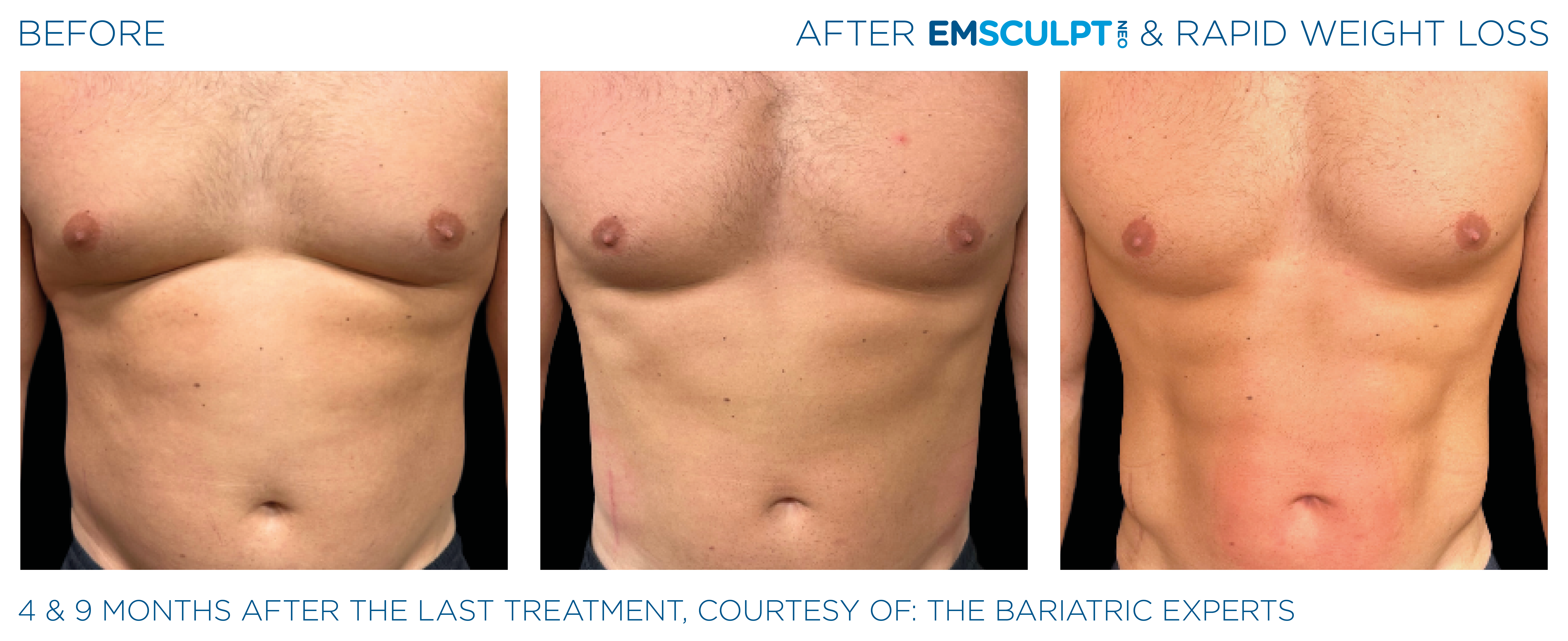 EMSCULPT NEO Results 6