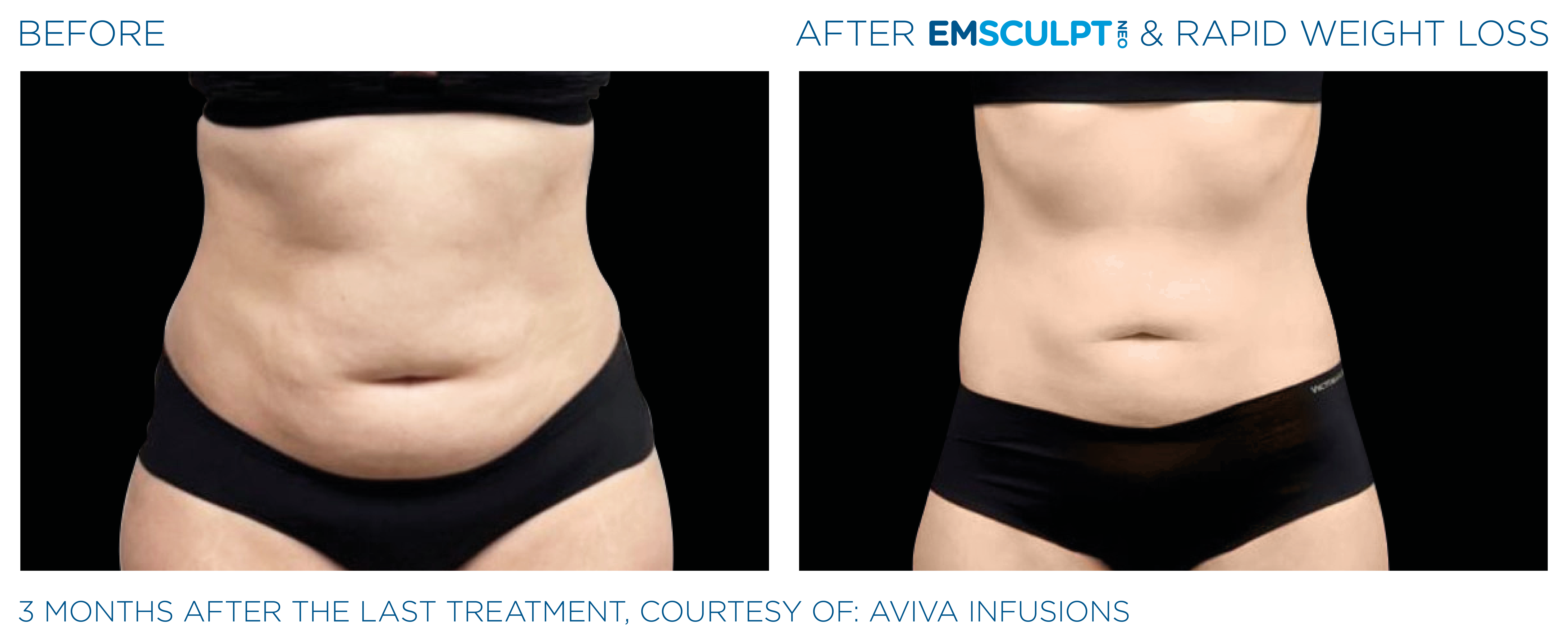 EMSCULPT NEO Results 4