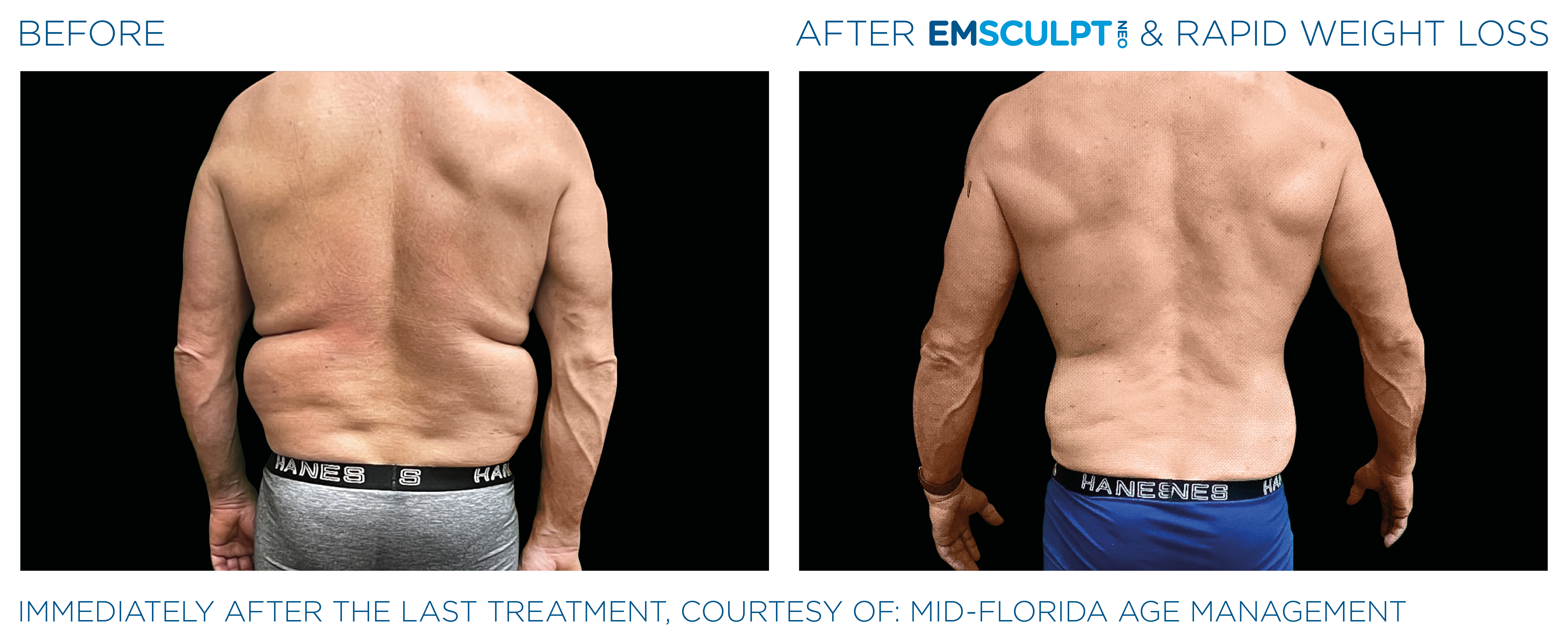 EMSCULPT NEO Results 1