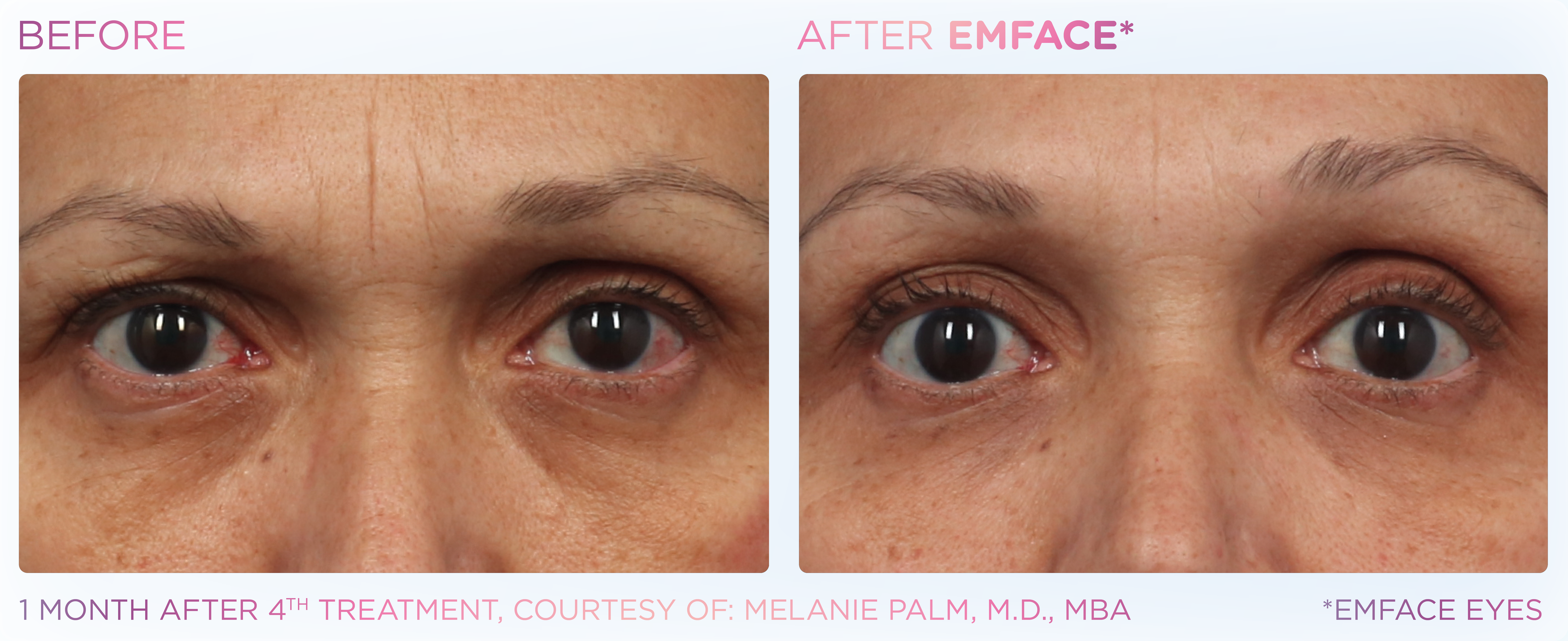 EMFACE Patient Results