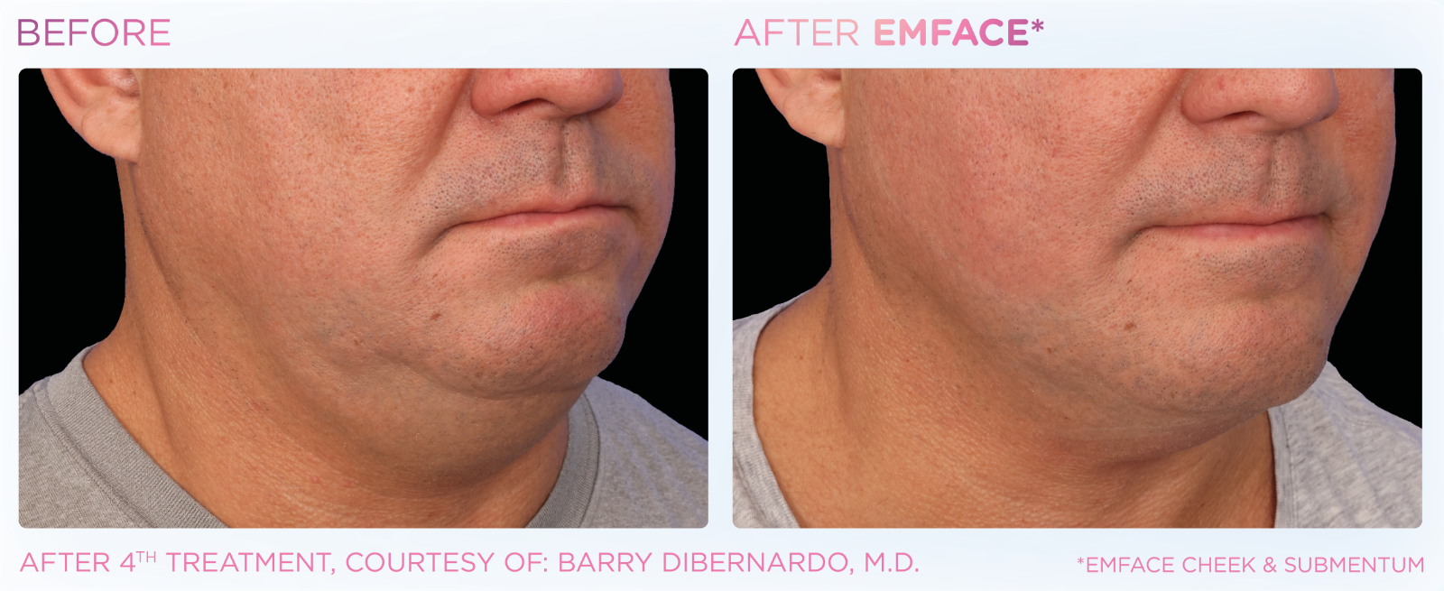 EMFACE Results