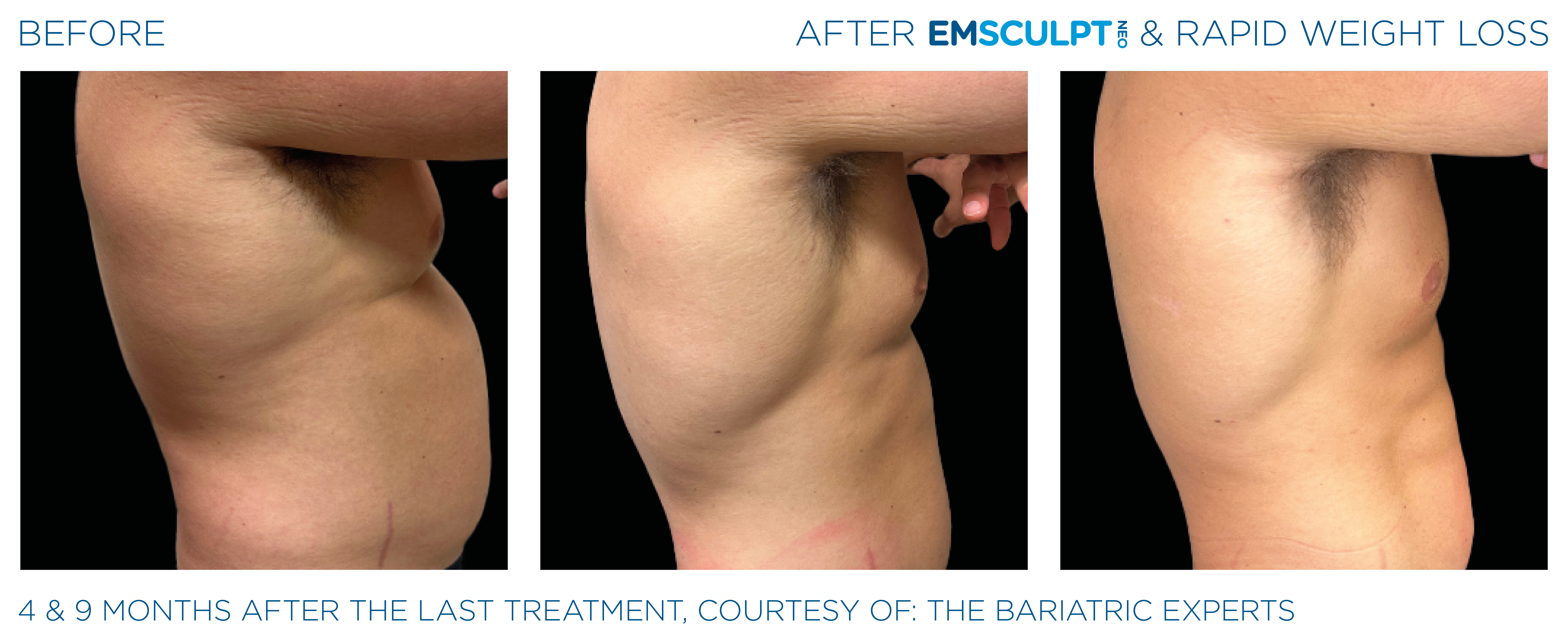 EMSCULPT NEO Results 8
